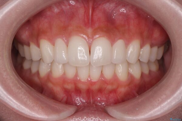 前歯のガタつきと矮小歯をインビザラインとセラミック治療で改善 治療後画像