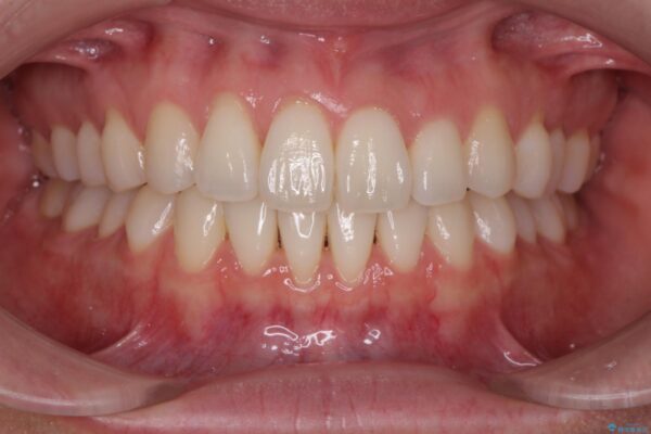 かみ合わない前歯、マウスピースで短期間矯正 治療後画像