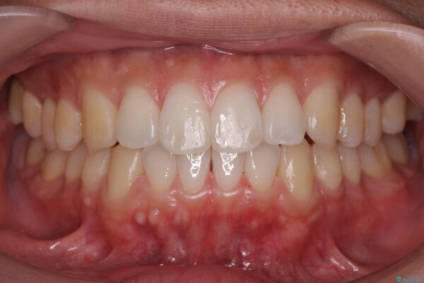 前歯のガタつきを短期間矯正 治療後画像