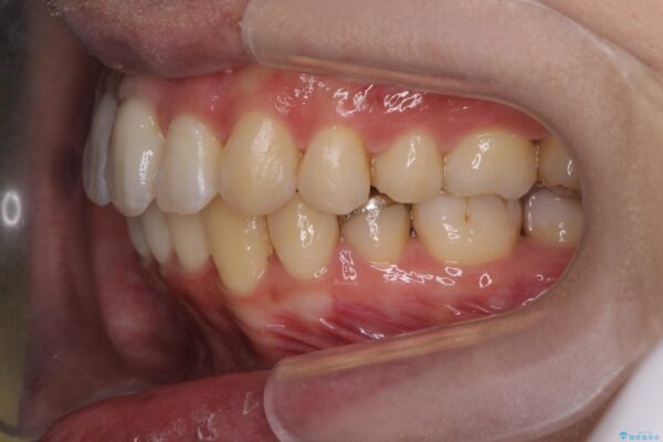気になる犬歯のガタつきをマウスピース矯正で改善 治療後画像