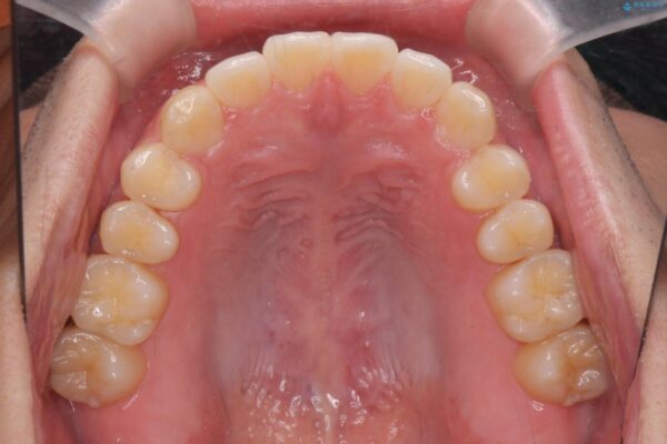 前歯のガタつきを短期間矯正 治療後画像