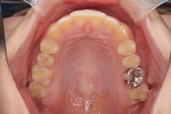 前歯の隙間と口元の突出感を改善したい 治療後画像