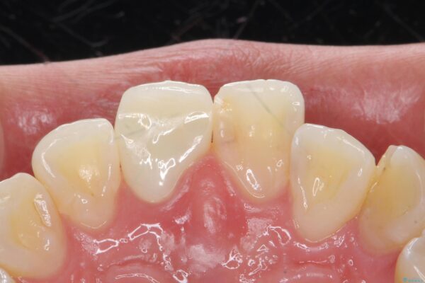 保険のかぶせ物の色が気になる 治療後画像