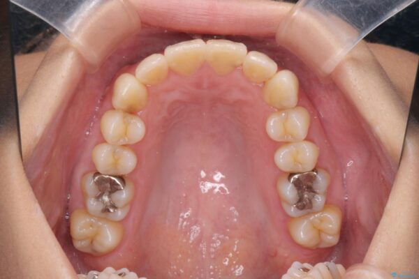 上下前歯のガタつきをインビザラインで改善 治療後画像