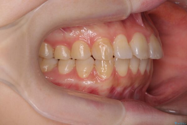 傾いた前歯、インビザラインで改善 治療後画像
