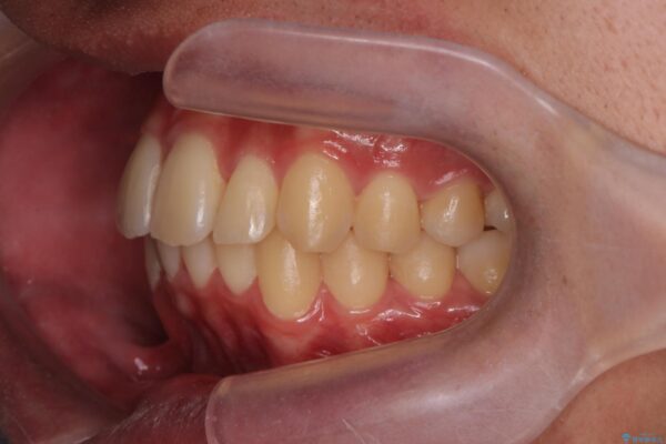 気になる出っ歯、インビザラインで改善 治療後画像