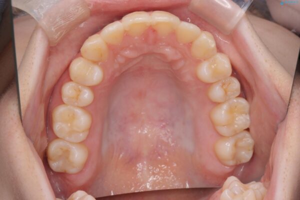 奥歯のガタつきをマウスピース矯正で改善 治療後画像