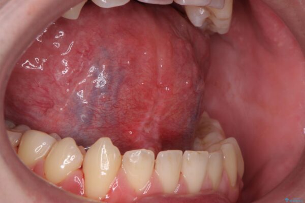 舌小帯を切除し滑舌を治したい 治療後画像