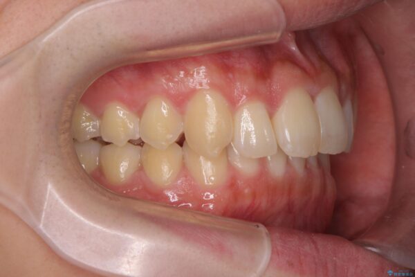 前歯のガタつきをマウスピース矯正で改善 治療後画像