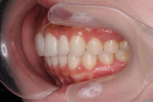 前歯のガタつきと矮小歯をインビザラインとセラミック治療で改善 治療後画像