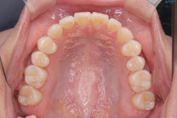 かみ合わない前歯、マウスピースで短期間矯正 治療後画像