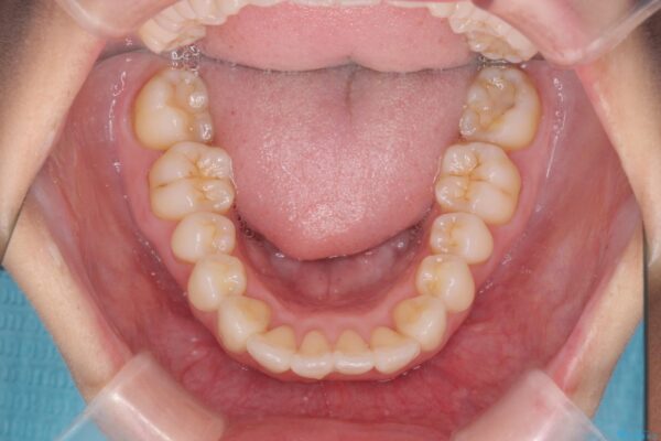 上下前歯のガタつきをインビザラインで改善 治療後画像