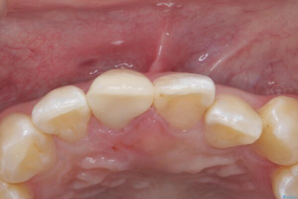 保険のかぶせ物の色が気になる 治療後画像