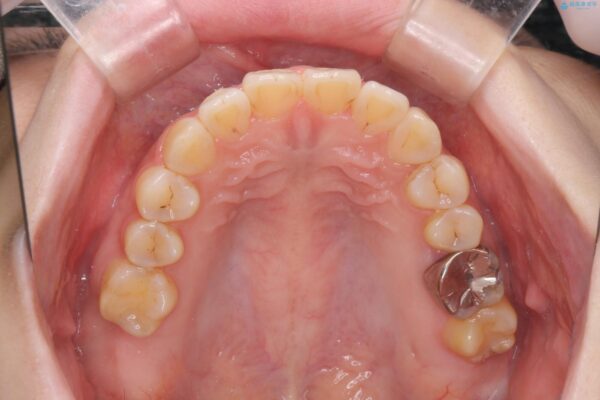 傾いた前歯、インビザラインで改善 治療後画像