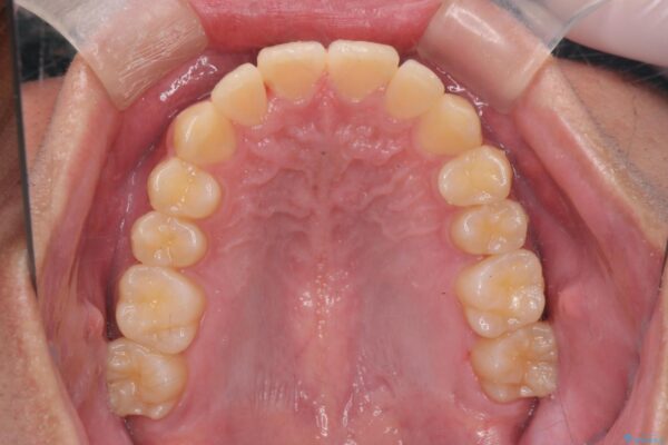 気になる出っ歯、インビザラインで改善 治療後画像