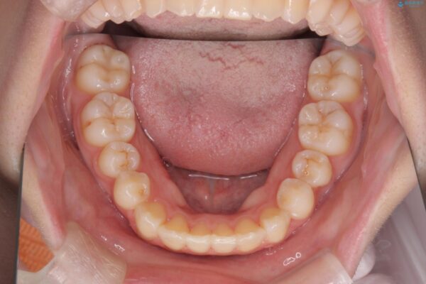奥歯のガタつきをマウスピース矯正で改善 治療後画像