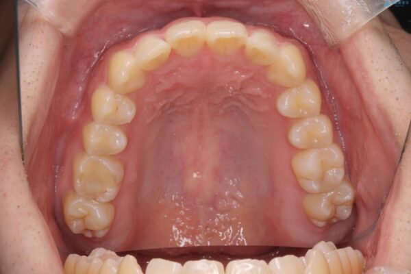 前歯のガタつきをマウスピース矯正で改善 治療後画像
