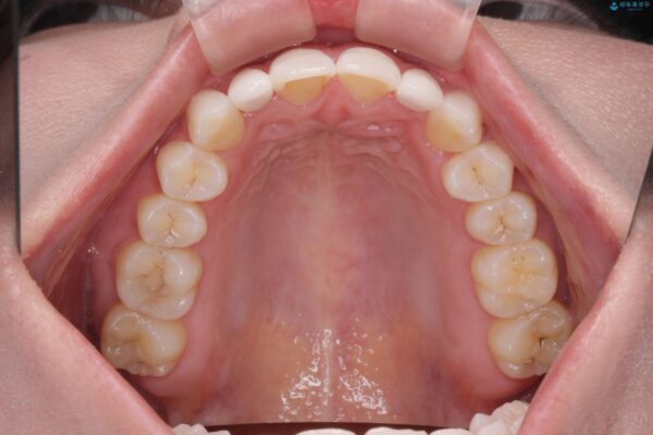 前歯のガタつきと矮小歯をインビザラインとセラミック治療で改善 治療後画像