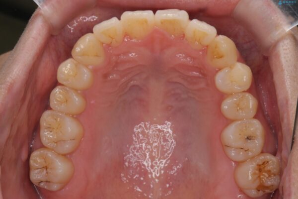 気になる犬歯のガタつきをマウスピース矯正で改善 治療後画像