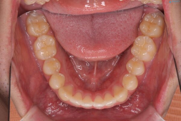 前歯のガタつきを短期間矯正 治療後画像