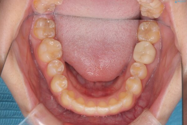 前歯の隙間と口元の突出感を改善したい 治療後画像