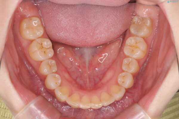 傾いた前歯、インビザラインで改善 治療後画像