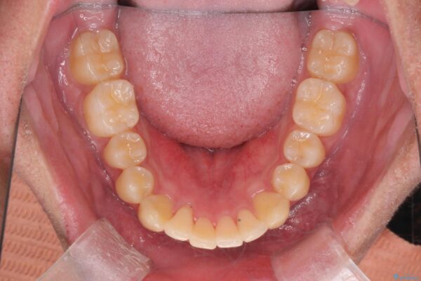 気になる出っ歯、インビザラインで改善 治療後画像