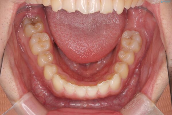 前歯のガタつきをマウスピース矯正で改善 治療後画像