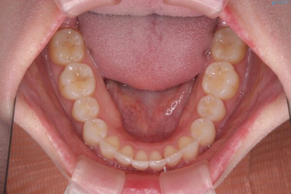 前歯のガタつきと矮小歯をインビザラインとセラミック治療で改善 治療後画像