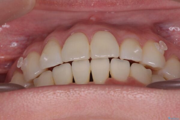 かみ合わない前歯、マウスピースで短期間矯正 治療後画像