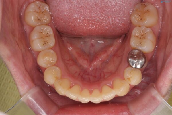 気になる犬歯のガタつきをマウスピース矯正で改善 治療後画像