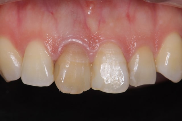 寿命 た 神経 抜い を 歯 歯の神経を抜く治療の前に知っておきたい歯の寿命との関係